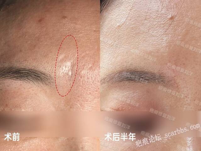 疤痕修复