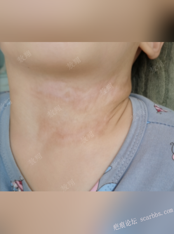 烧烫伤疤痕增生发硬要重视，避免挛缩畸形 