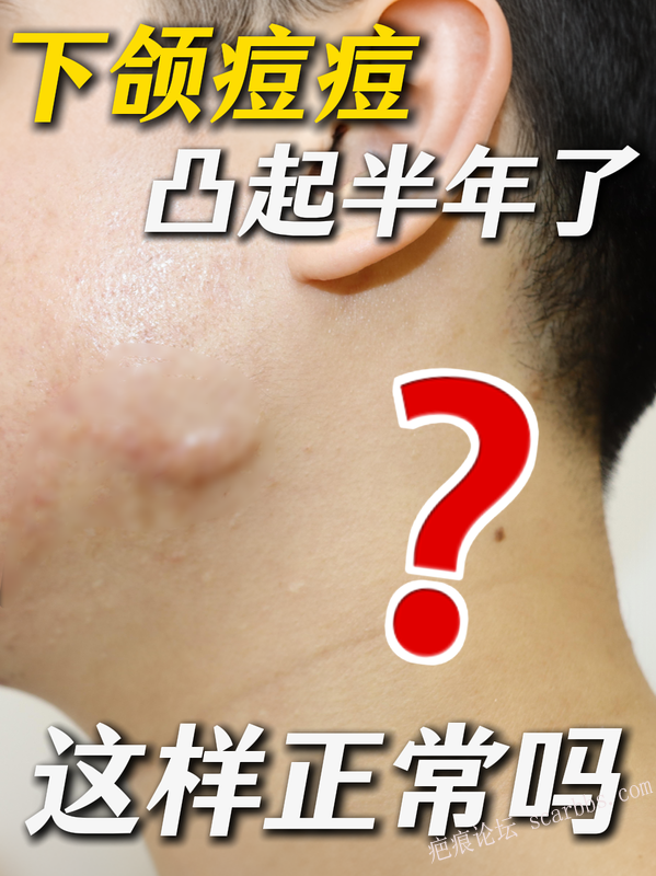下颌痘痘半年不消？可能是疤痕疙瘩！