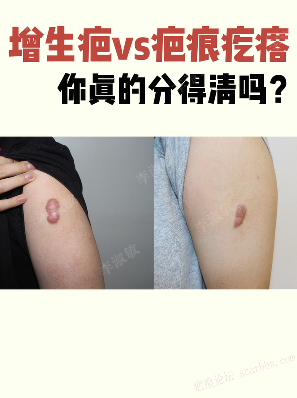 增生疤痕和疤痕疙瘩，有什么区别？