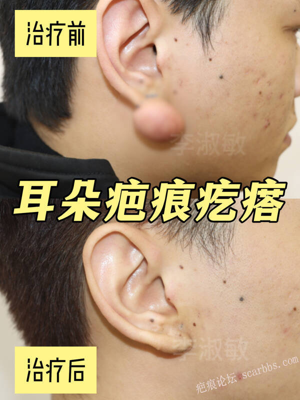 耳朵疤痕疙瘩切7次都复发，现在终于上岸了