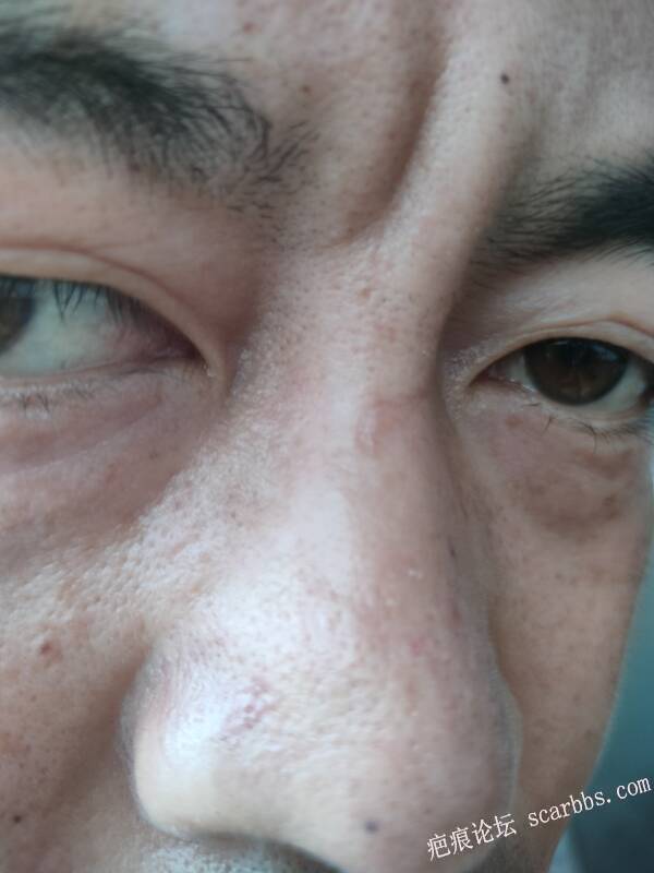 疤痕一般几个月定型 