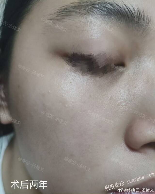 疤痕修复