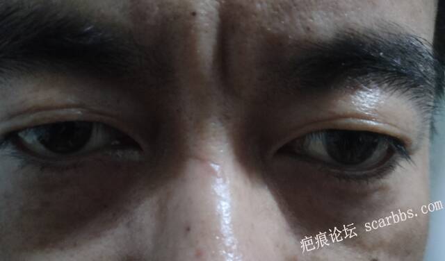 疤痕一般几个月定型 