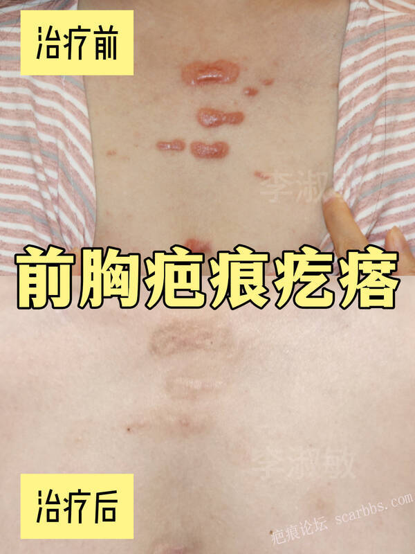 前胸肩胛疤痕疙瘩十几年，保守治平了