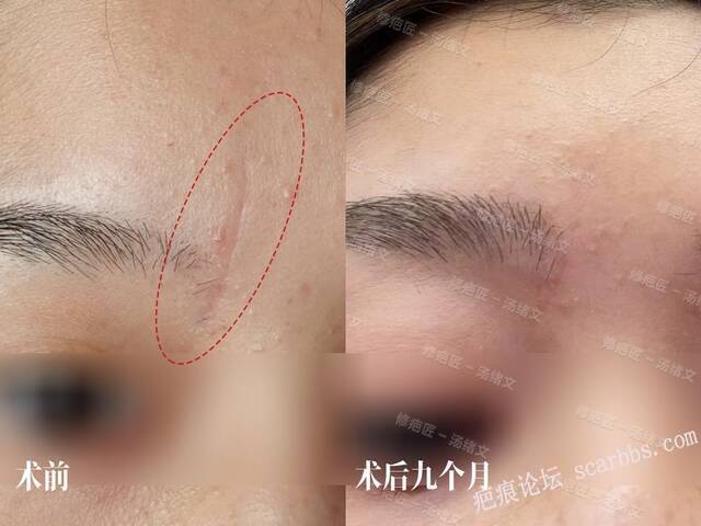 眉间疤痕修复