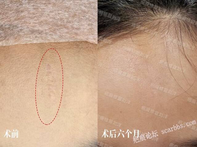 疤痕修复