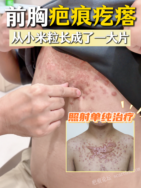 前胸大片疤痕疙瘩，终于有救了