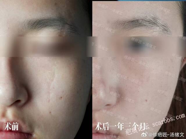 疤痕修复