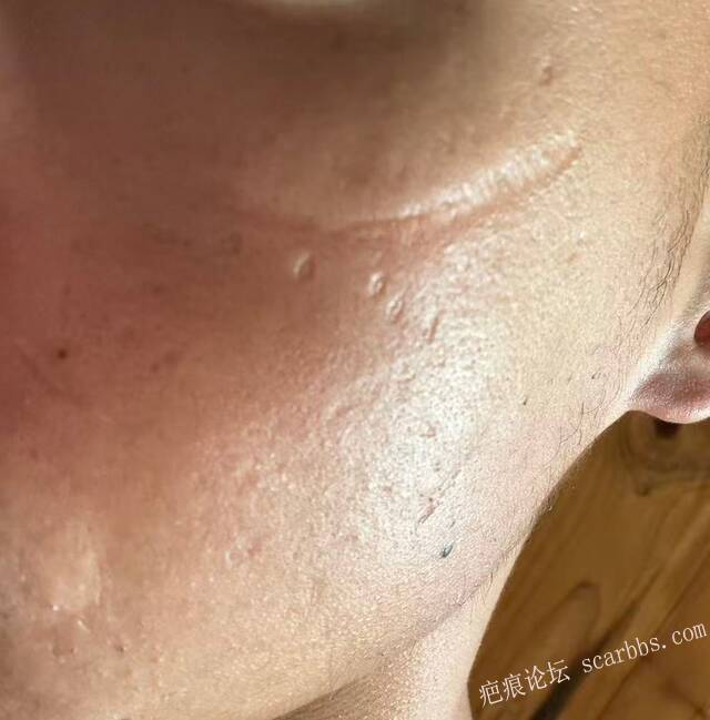 十几年的疤痕如何修复，求推荐医生