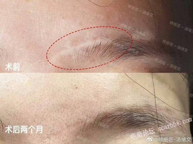 疤痕修复