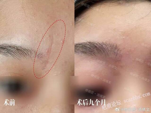 疤痕修复