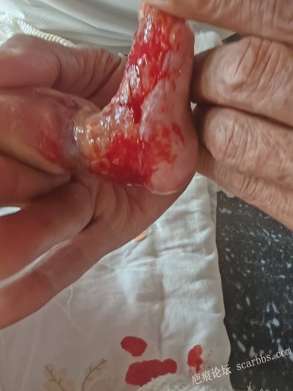 李高令老了，确真的很苦恼！走路腿还疼…今天却必须要岀一次远门。（北京新生儿皮缺… 