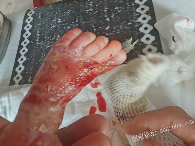 李高令老了，确真的很苦恼！走路腿还疼…今天却必须要岀一次远门。（北京新生儿皮缺… 