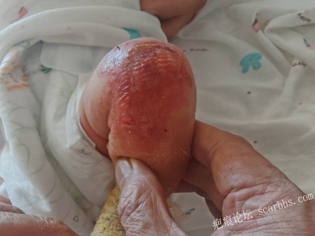 李高令老了，确真的很苦恼！走路腿还疼…今天却必须要岀一次远门。（北京新生儿皮缺… 