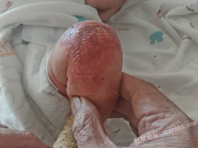 李高令老了，确真的很苦恼！走路腿还疼…今天却必须要岀一次远门。（北京新生儿皮缺… 