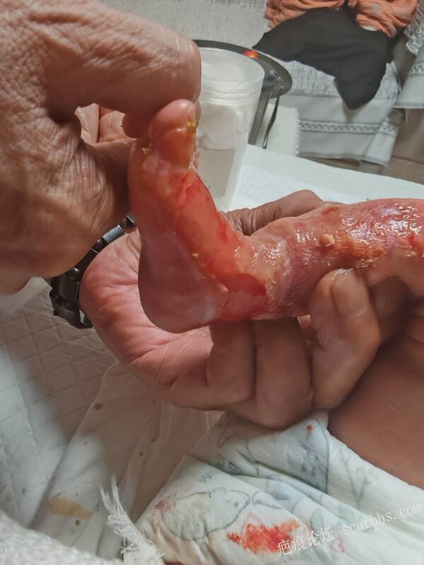 李高令老了，确真的很苦恼！走路腿还疼…今天却必须要岀一次远门。（北京新生儿皮缺… 