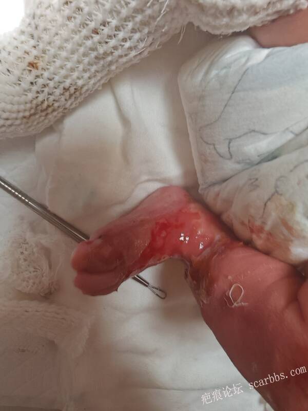 李高令老了，确真的很苦恼！走路腿还疼…今天却必须要岀一次远门。（北京新生儿皮缺… 