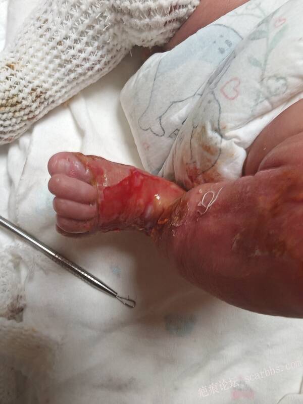 李高令老了，确真的很苦恼！走路腿还疼…今天却必须要岀一次远门。（北京新生儿皮缺… 