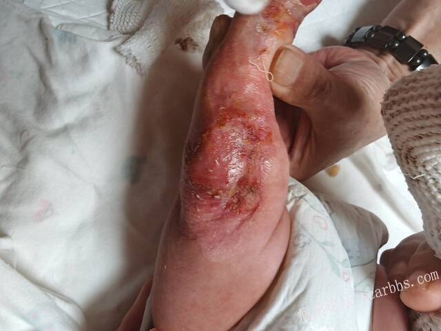李高令老了，确真的很苦恼！走路腿还疼…今天却必须要岀一次远门。（北京新生儿皮缺… 