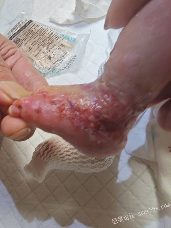 李高令老了，确真的很苦恼！走路腿还疼…今天却必须要岀一次远门。（北京新生儿皮缺… 