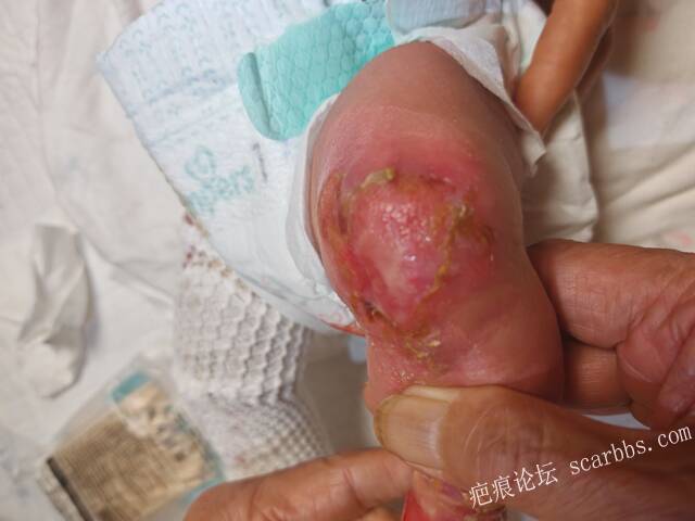 李高令老了，确真的很苦恼！走路腿还疼…今天却必须要岀一次远门。（北京新生儿皮缺… 