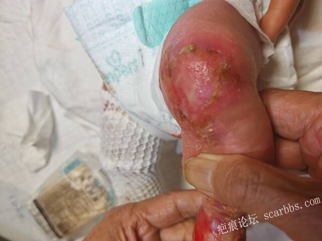 李高令老了，确真的很苦恼！走路腿还疼…今天却必须要岀一次远门。（北京新生儿皮缺… 