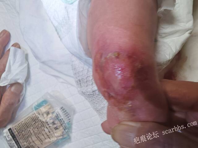 李高令老了，确真的很苦恼！走路腿还疼…今天却必须要岀一次远门。（北京新生儿皮缺… 