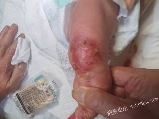 李高令老了，确真的很苦恼！走路腿还疼…今天却必须要岀一次远门。（北京新生儿皮缺… 
