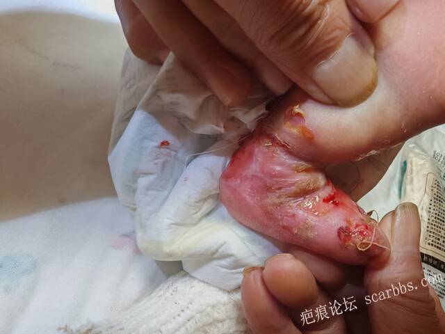 李高令老了，确真的很苦恼！走路腿还疼…今天却必须要岀一次远门。（北京新生儿皮缺… 