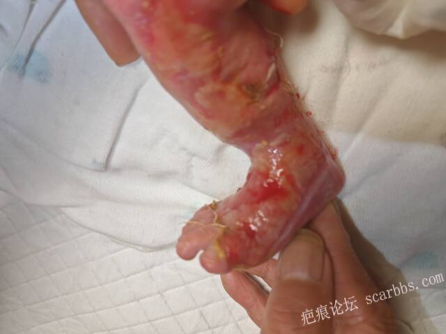 李高令老了，确真的很苦恼！走路腿还疼…今天却必须要岀一次远门。（北京新生儿皮缺… 