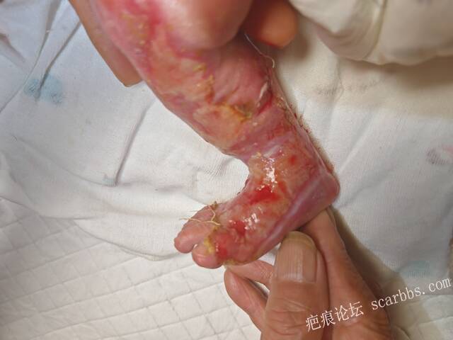 李高令老了，确真的很苦恼！走路腿还疼…今天却必须要岀一次远门。（北京新生儿皮缺… 