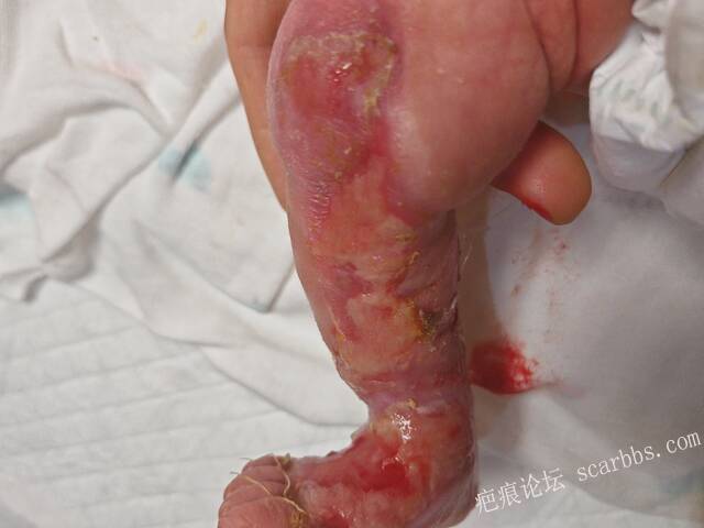 李高令老了，确真的很苦恼！走路腿还疼…今天却必须要岀一次远门。（北京新生儿皮缺… 