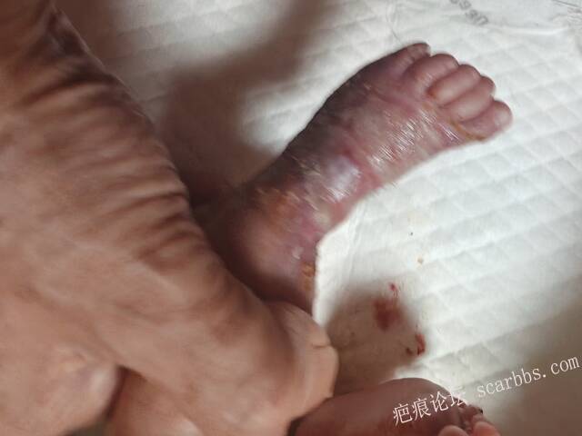 老了，确真的很苦恼！走路腿还疼…今天却必须要岀一次远门。（北京新生儿皮缺…） 
