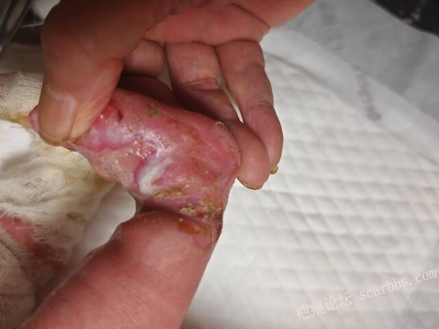 老了，确真的很苦恼！走路腿还疼…今天却必须要岀一次远门。（北京新生儿皮缺…） 