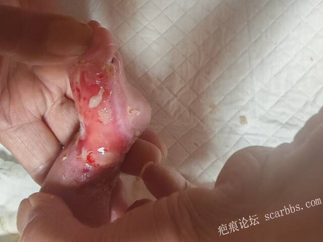 老了，确真的很苦恼！走路腿还疼…今天却必须要岀一次远门。（北京新生儿皮缺…） 