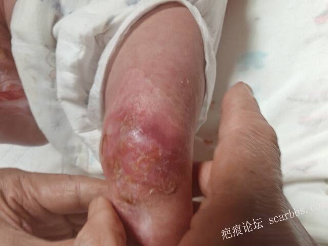老了，确真的很苦恼！走路腿还疼…今天却必须要岀一次远门。（北京新生儿皮缺…） 
