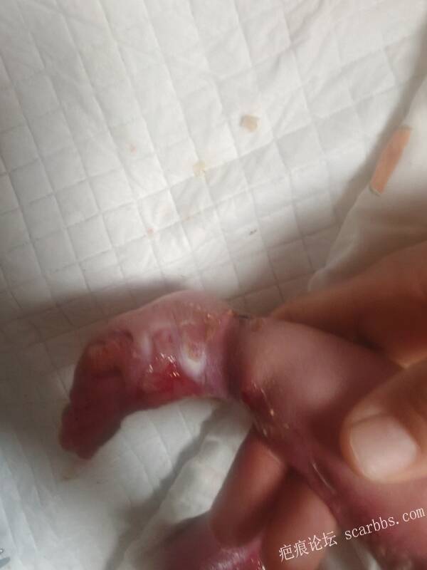 老了，确真的很苦恼！走路腿还疼…今天却必须要岀一次远门。（北京新生儿皮缺…） 