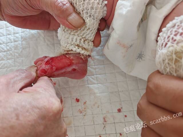 老了，确真的很苦恼！走路腿还疼…今天却必须要岀一次远门。（北京新生儿皮缺…） 