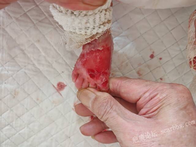 老了，确真的很苦恼！走路腿还疼…今天却必须要岀一次远门。（北京新生儿皮缺…） 