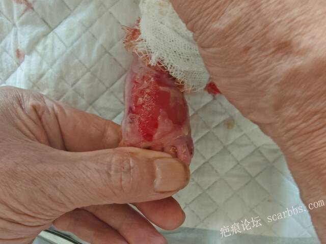 老了，确真的很苦恼！走路腿还疼…今天却必须要岀一次远门。（北京新生儿皮缺…） 