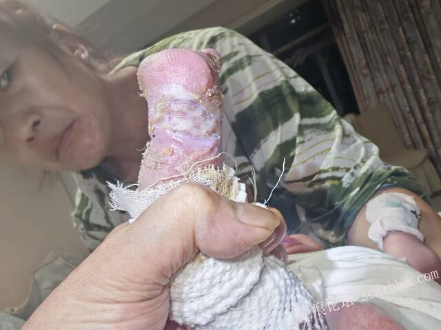 李高令老了，确真的很苦恼！走路腿还疼…今天却必须要岀一次远门。（北京新生儿皮缺… 