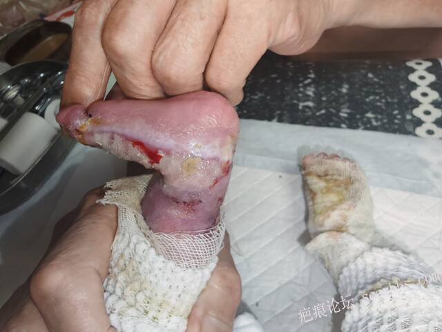 李高令老了，确真的很苦恼！走路腿还疼…今天却必须要岀一次远门。（北京新生儿皮缺… 