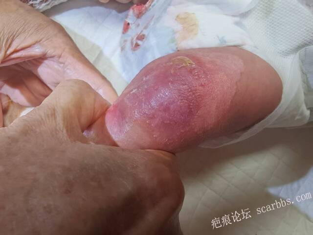 李高令老了，确真的很苦恼！走路腿还疼…今天却必须要岀一次远门。（北京新生儿皮缺… 