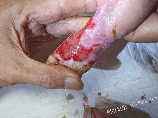 李高令老了，确真的很苦恼！走路腿还疼…今天却必须要岀一次远门。（北京新生儿皮缺… 