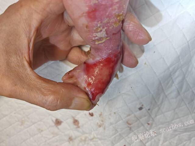 李高令老了，确真的很苦恼！走路腿还疼…今天却必须要岀一次远门。（北京新生儿皮缺… 