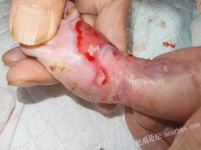 李高令老了，确真的很苦恼！走路腿还疼…今天却必须要岀一次远门。（北京新生儿皮缺… 