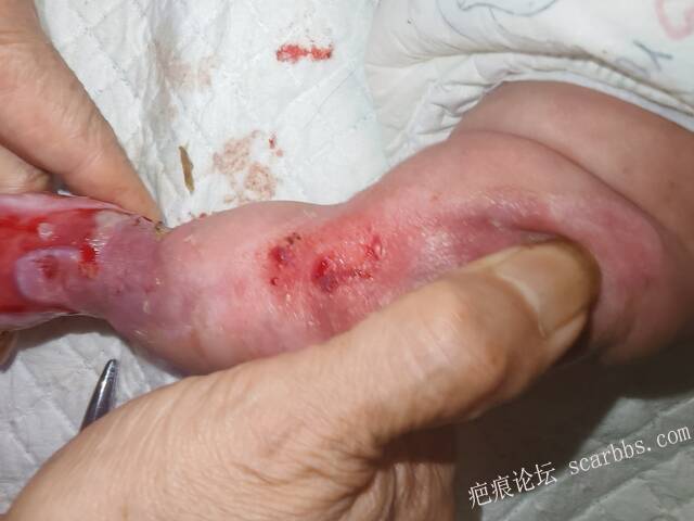 李高令老了，确真的很苦恼！走路腿还疼…今天却必须要岀一次远门。（北京新生儿皮缺… 