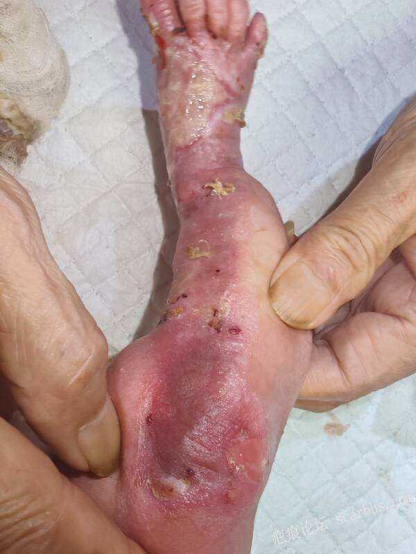 李高令老了，确真的很苦恼！走路腿还疼…今天却必须要岀一次远门。（北京新生儿皮缺… 