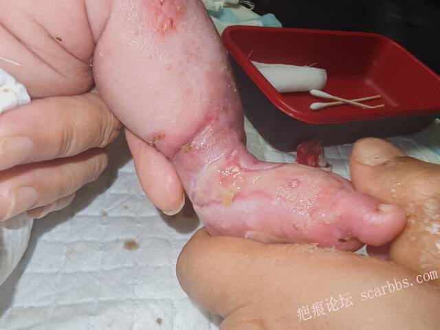 李高令老了，确真的很苦恼！走路腿还疼…今天却必须要岀一次远门。（北京新生儿皮缺… 